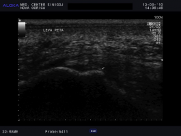 Ultrazvok pete - trn petnice, spina calcanea, indikacija ESWT 2